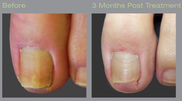 Before-and-After-Laser-1.jpg