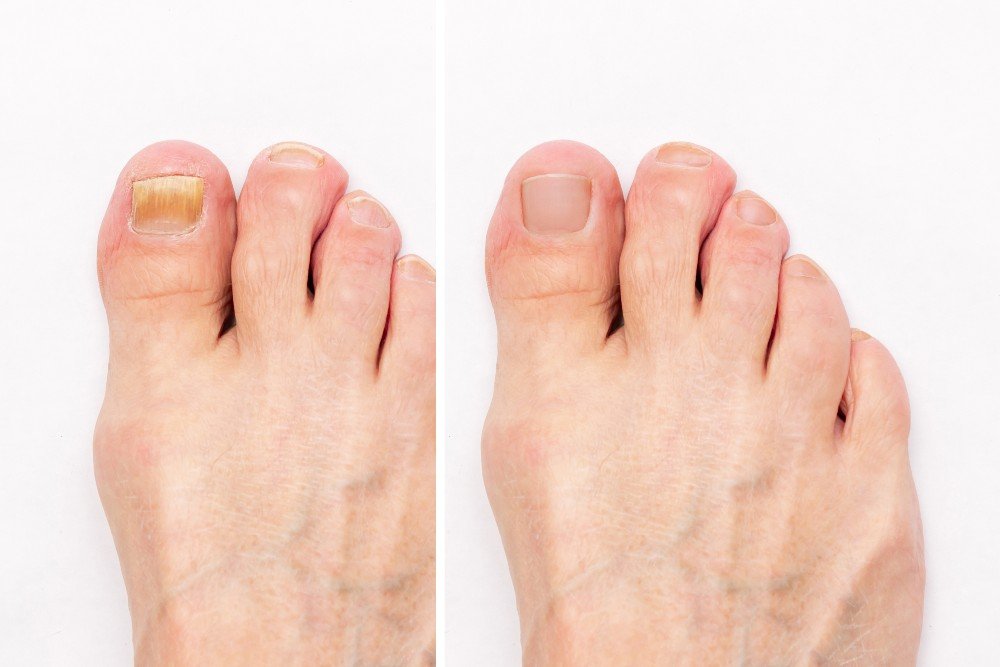 Before-and-after-toenail-fungus-treatment.jpg
