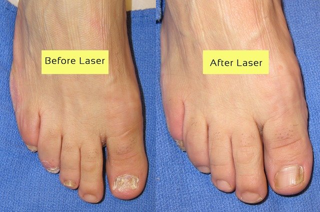 Cutera-Laser-Before-and-After-Picture-p01.jpg
