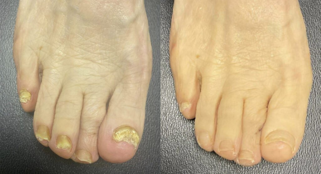 Toenail-Fungus-Before-and-After-Photo-by-Oregon-Institute-of-Foot-Care-in-Lake-Oswego-OR-1.jpg
